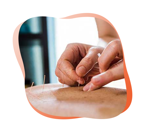 ACUPUNCTURE